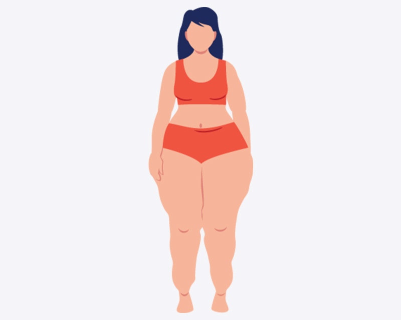 Illustration of a woman with lipoedema, showing disproportionate enlargement of legs and hips compared to the waist. Illustration of a woman with lipoedema, showing disproportionate enlargement of legs and hips compared to the waist.